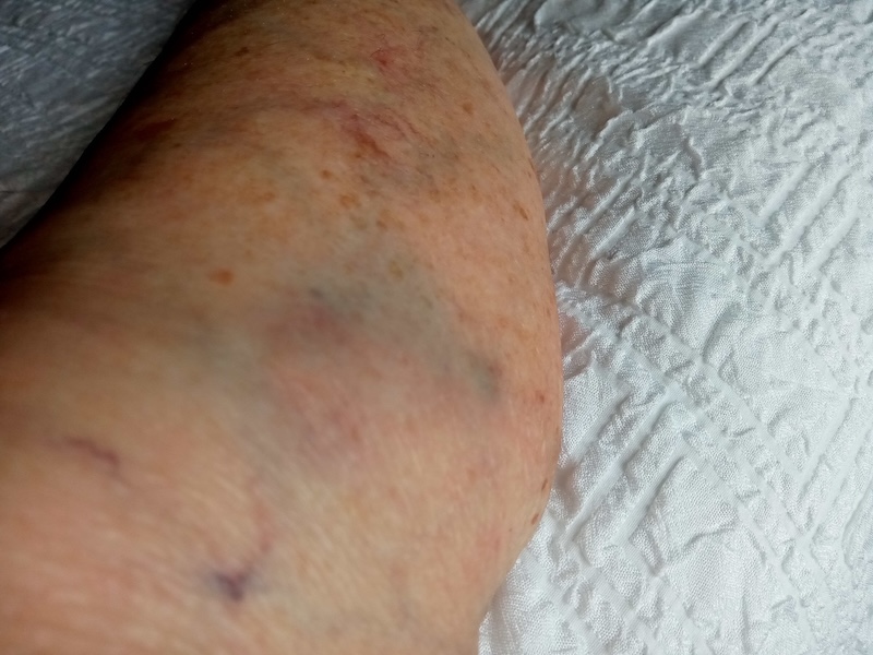My knee and lower leg injuries … will be rapid heal
